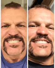 Load image into Gallery viewer, Snow® At-Home Teeth Whitening (ALL-IN-ONE KIT)