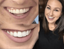 Load image into Gallery viewer, GRONK's Snow® Teeth Whitening At-Home System [All-in-One Kit]
