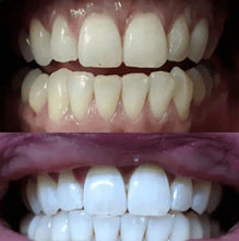 Load image into Gallery viewer, GRONK's Snow® Teeth Whitening At-Home System [All-in-One Kit]
