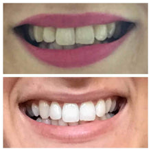 Load image into Gallery viewer, GRONK's Snow® Teeth Whitening At-Home System [All-in-One Kit]
