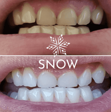 Load image into Gallery viewer, SNOW® SENSITIVE TEETH WHITENING AT-HOME SYSTEM [ALL-IN-ONE KIT]

