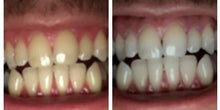 Load image into Gallery viewer, GRONK's Snow® Teeth Whitening At-Home System [All-in-One Kit]
