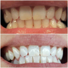 Load image into Gallery viewer, GRONK's Snow® Teeth Whitening At-Home System [All-in-One Kit]

